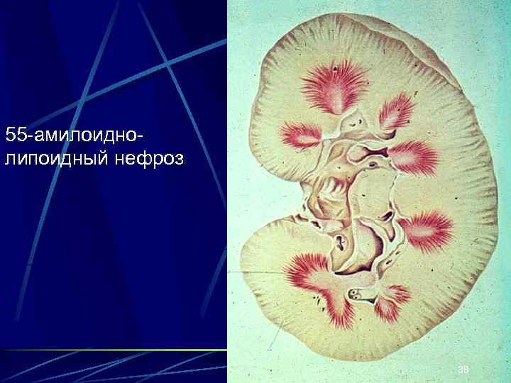55 -амилоиднолипоидный нефроз 38 