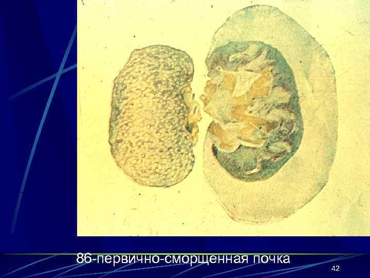 86 -первично-сморщенная почка 42 