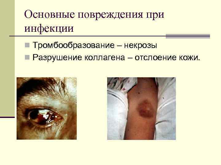 Основные повреждения при инфекции n Тромбообразование – некрозы n Разрушение коллагена – отслоение кожи.