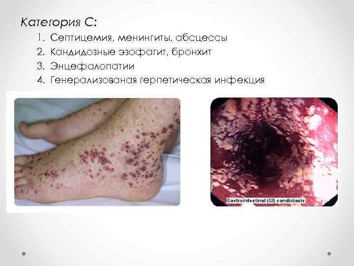 Категория С: 1. 2. 3. 4. Септицемия, менингиты, абсцессы Кандидозные эзофагит, бронхит Энцефалопатии Генерализованая