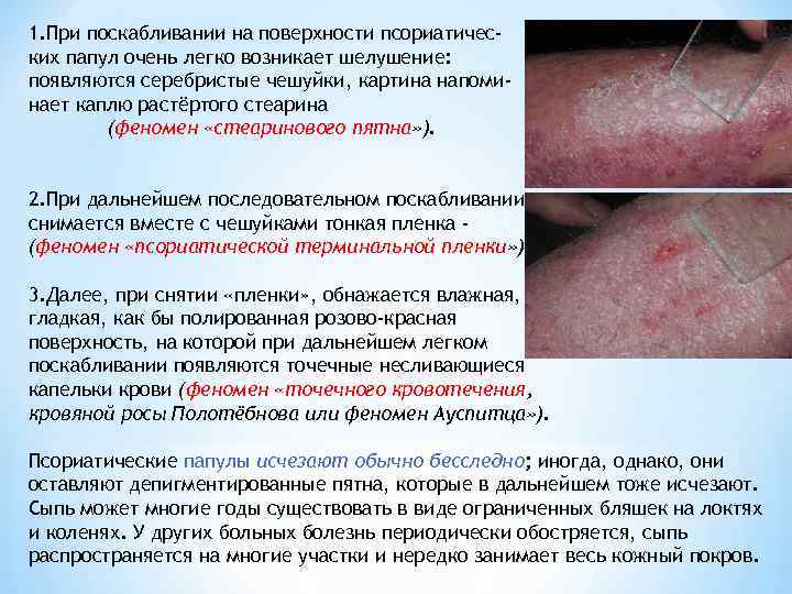 1. При поскабливании на поверхности псориатических папул очень легко возникает шелушение: появляются серебристые чешуйки,