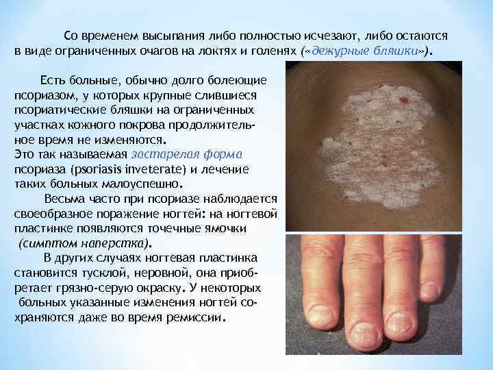 Со временем высыпания либо полностью исчезают, либо остаются в виде ограниченных очагов на локтях