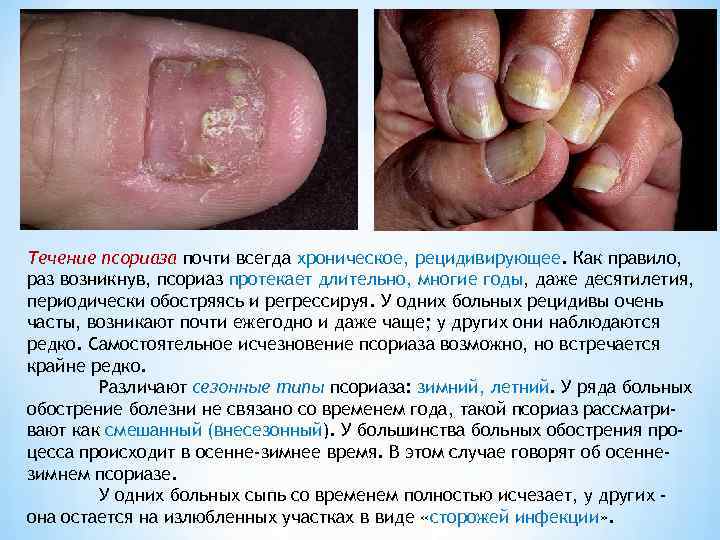 Течение псориаза почти всегда хроническое, рецидивирующее. Как правило, раз возникнув, псориаз протекает длительно, многие