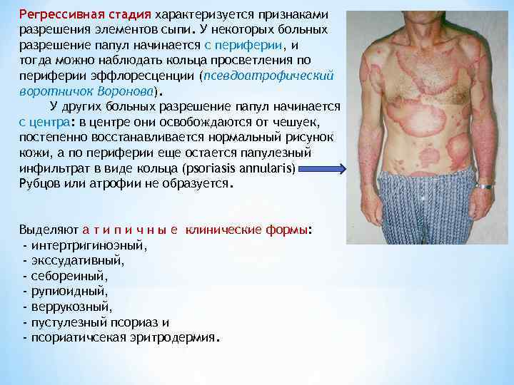 Регрессивная стадия характеризуется признаками разрешения элементов сыпи. У некоторых больных разрешение папул начинается с