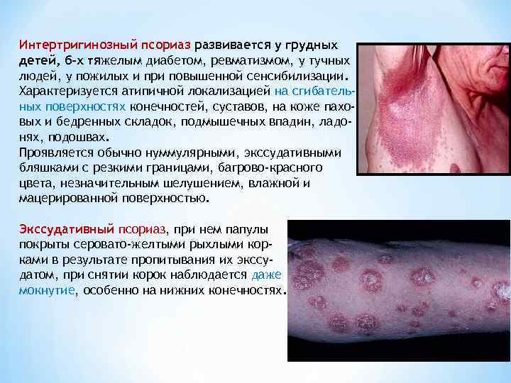 Интертригинозный псориаз развивается у грудных детей, б-х тяжелым диабетом, ревматизмом, у тучных людей, у