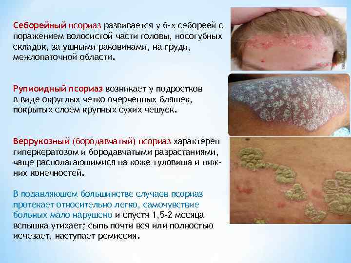 Себорейный псориаз развивается у б-х себореей с поражением волосистой части головы, носогубных складок, за