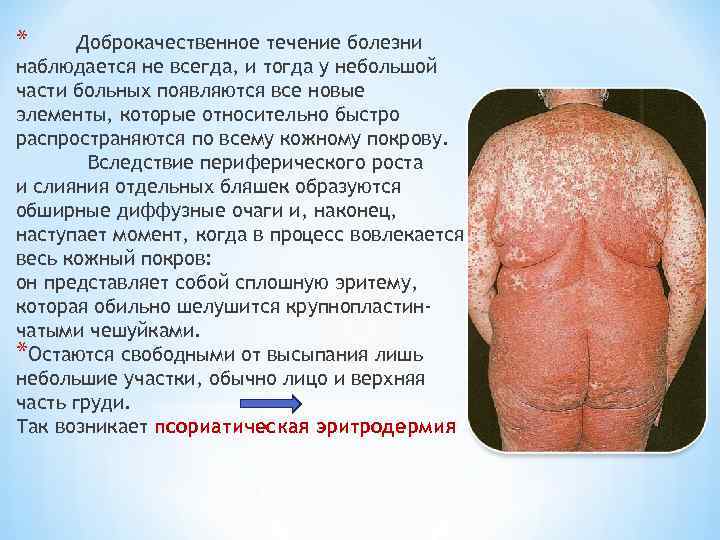 * Доброкачественное течение болезни наблюдается не всегда, и тогда у небольшой части больных появляются