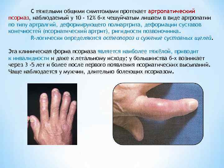С тяжелыми общими симптомами протекает артропатический псориаз, наблюдаемый у 10 - 12% б-х чешуйчатым