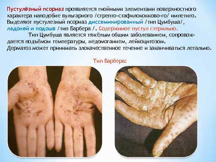 Пустулёзный псориаз проявляется гнойными элементами поверхностного характера наподобие вульгарного /стрепто-стафилококково-го/ импетиго. Выделяют пустулезный псориаз