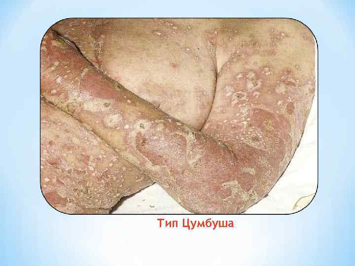 * Тип Цумбуша 