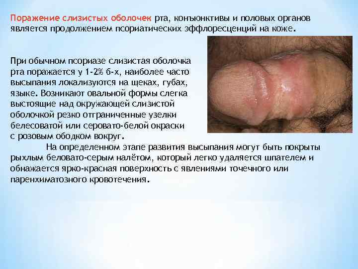 Поражение слизистых оболочек рта, конъюнктивы и половых органов является продолжением псориатических эффлоресценций на коже.