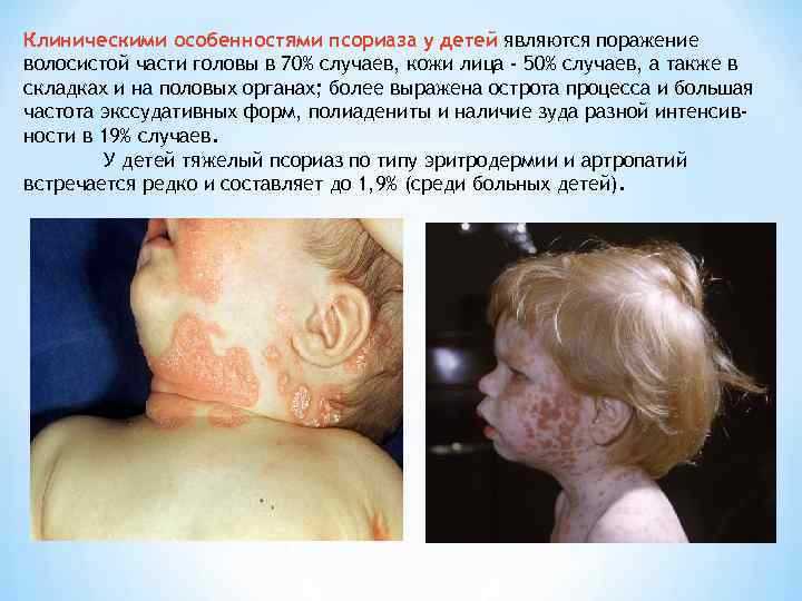 Клиническими особенностями псориаза у детей являются поражение волосистой части головы в 70% случаев, кожи