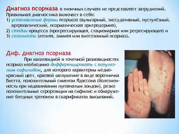 Диагноз псориаза в типичных случаях не представляет затруднений. Правильная диагностика включает в себя: 1)