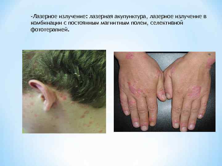 -Лазерное излучение: лазерная акупунктура, лазерное излучение в комбинации с постоянным магнитным полем, селективной фототерапией.