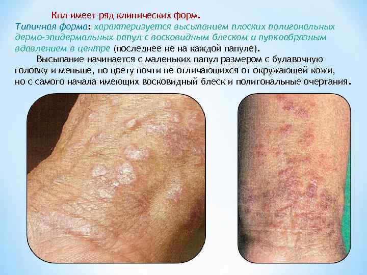 Кпл имеет ряд клинических форм. Типичная форма: характеризуется высыпанием плоских полигональных дермо-эпидермальных папул с