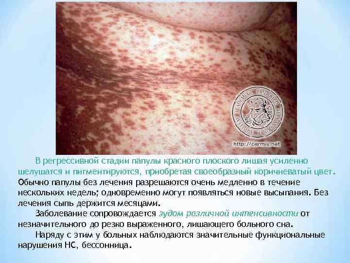 В регрессивной стадии папулы красного плоского лишая усиленно шелушатся и пигментируются, приобретая своеобразный коричневатый