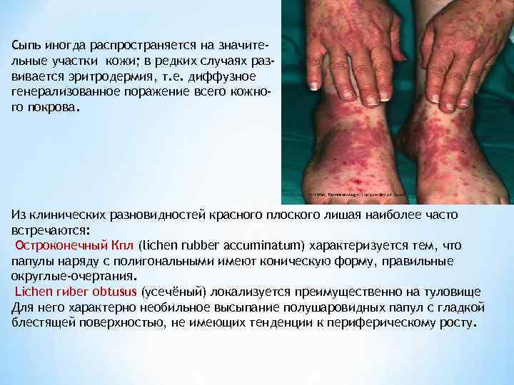 Сыпь иногда распространяется на значительные участки кожи; в редких случаях развивается эритродермия, т. е.