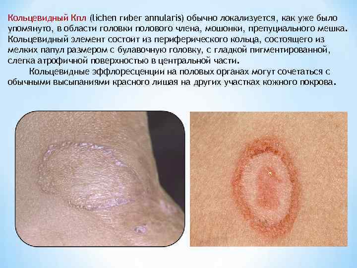 Кольцевидный Кпл (lichen гиbег annularis) обычно локализуется, как уже было упомянуто, в области головки