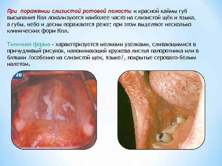 При поражении слизистой ротовой полости и красной каймы губ высыпания Кпл локализуются наиболее часто