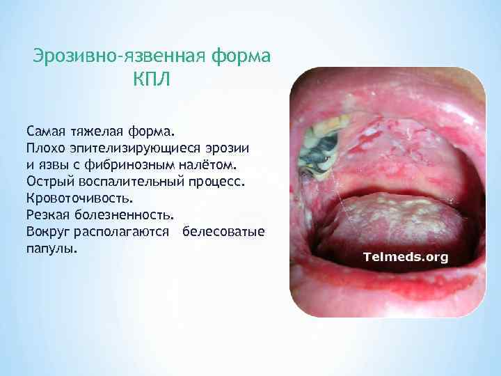 Эрозивно-язвенная форма КПЛ Самая тяжелая форма. Плохо эпителизирующиеся эрозии и язвы с фибринозным налётом.