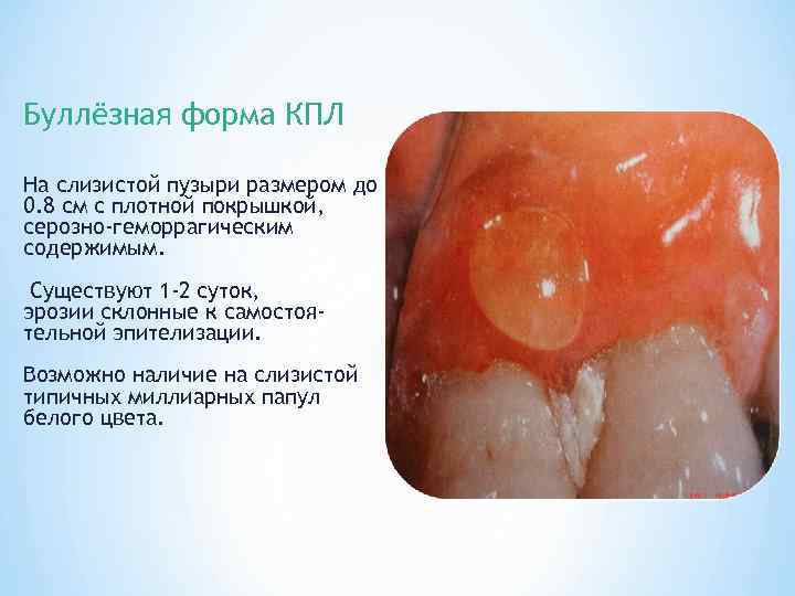 Буллёзная форма КПЛ На слизистой пузыри размером до 0. 8 см с плотной покрышкой,