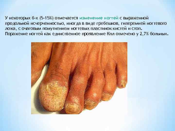 У некоторых б-х (5 -15%) отмечается изменение ногтей с выраженной продольной исчерченностью, иногда в