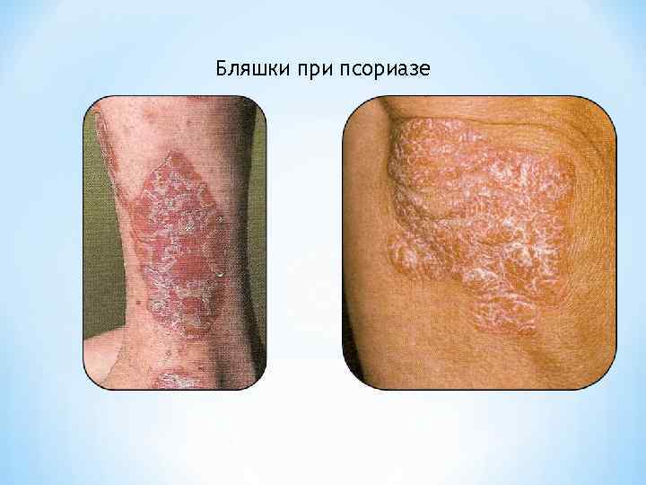 Бляшки при псориазе 
