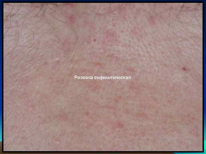 Розеола сифилитическая 
