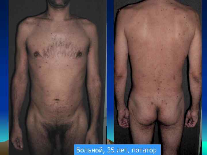 Больной, 35 лет, потатор 