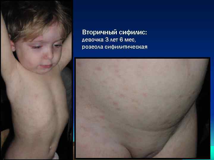 Вторичный сифилис: девочка 3 лет 6 мес, розеола сифилитическая 