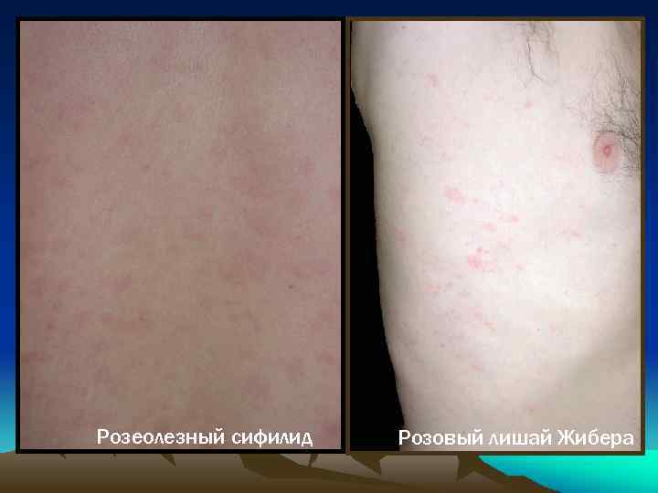 Розеолезный сифилид Розовый лишай Жибера 
