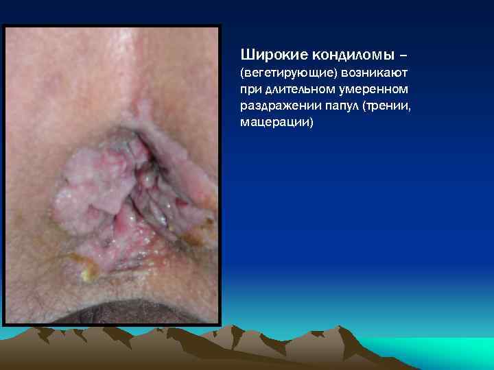 Широкие кондиломы – (вегетирующие) возникают при длительном умеренном раздражении папул (трении, мацерации) 