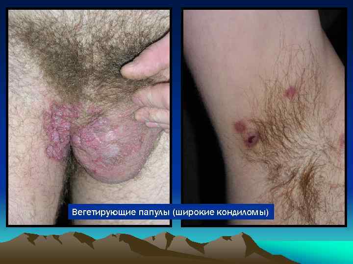 Вегетирующие папулы (широкие кондиломы) 