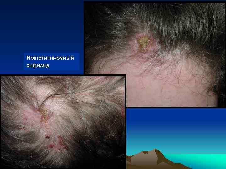 Импетигинозный сифилид 