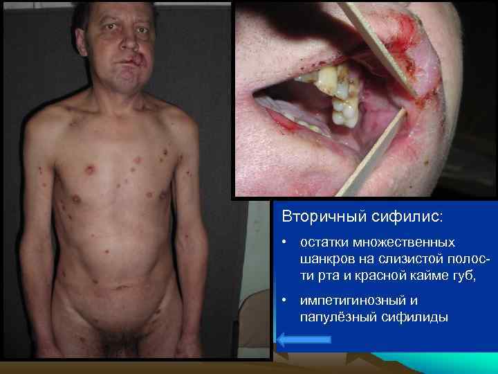 Вторичный сифилис: • остатки множественных шанкров на слизистой полости рта и красной кайме губ,
