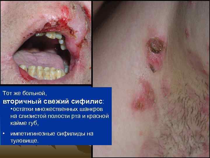 Тот же больной, вторичный свежий сифилис: • остатки множественных шанкров на слизистой полости рта