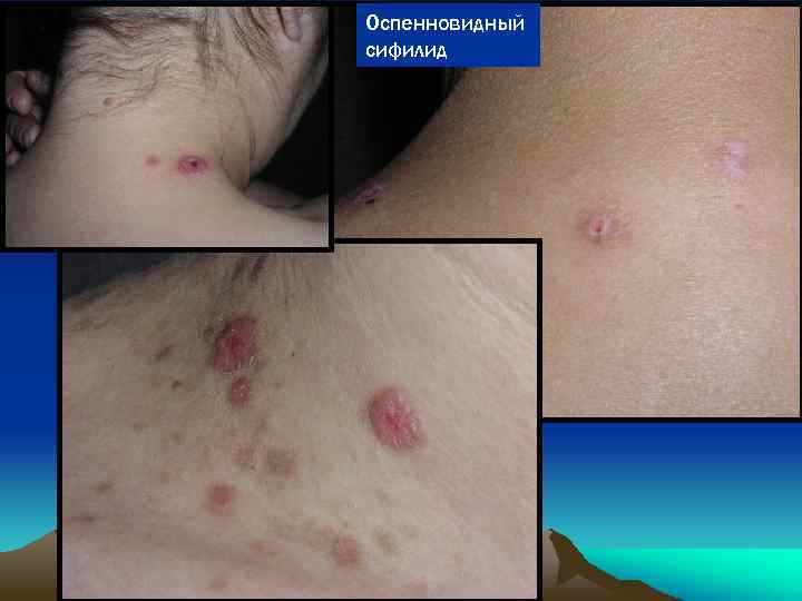 Оспенновидный сифилид 