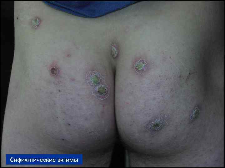 Сифилитические эктимы 