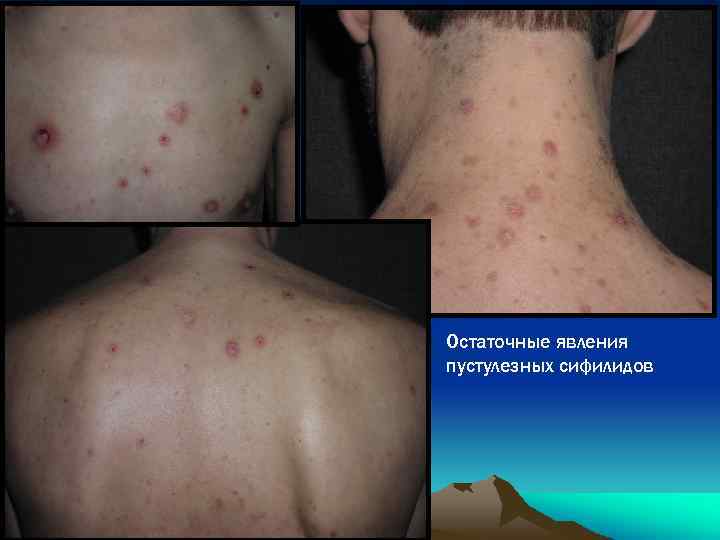 Остаточные явления пустулезных сифилидов 