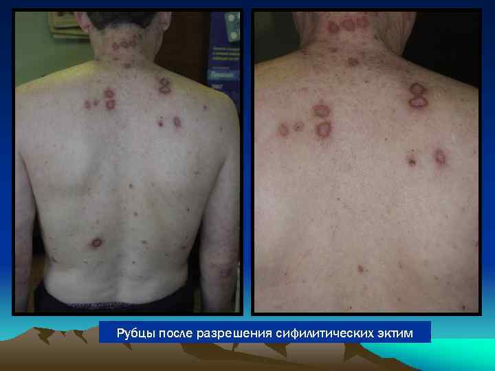 Рубцы после разрешения сифилитических эктим 