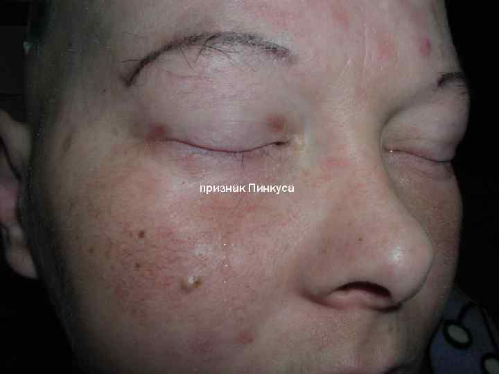 признак Пинкуса 