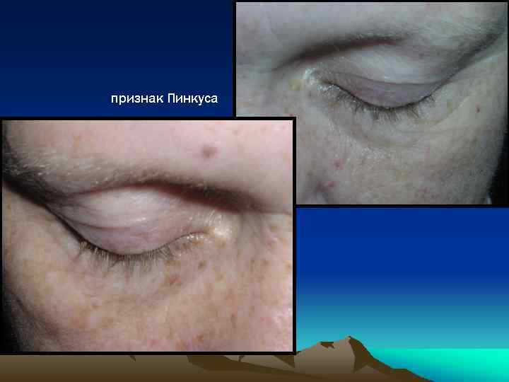 признак Пинкуса 