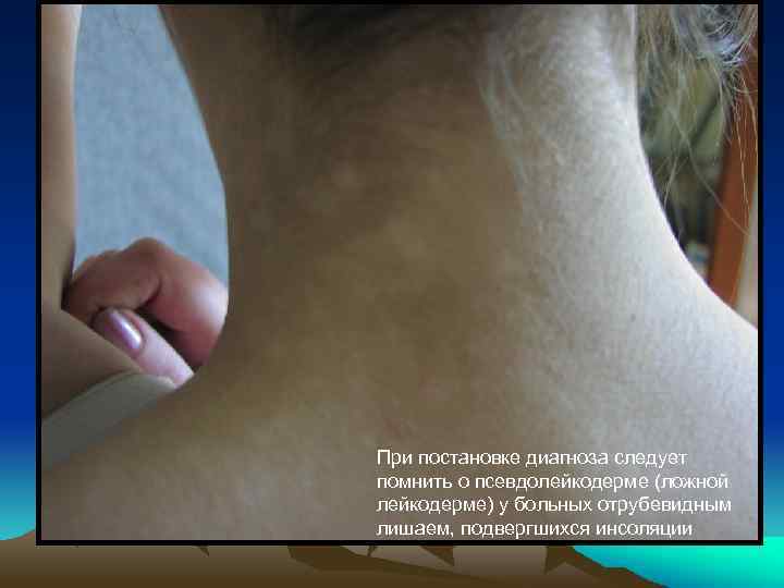 При постановке диагноза следует помнить о псевдолейкодерме (ложной лейкодерме) у больных отрубевидным лишаем, подвергшихся