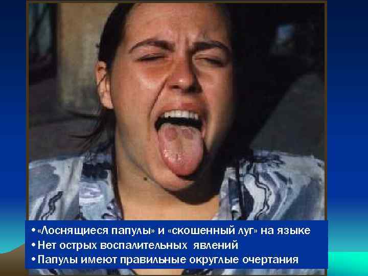  • «Лоснящиеся папулы» и «скошенный луг» на языке • Нет острых воспалительных явлений