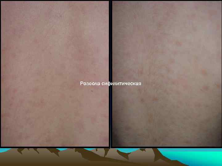 Розеола сифилитическая 
