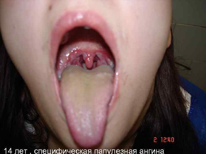 14 лет , специфическая папулезная ангина 