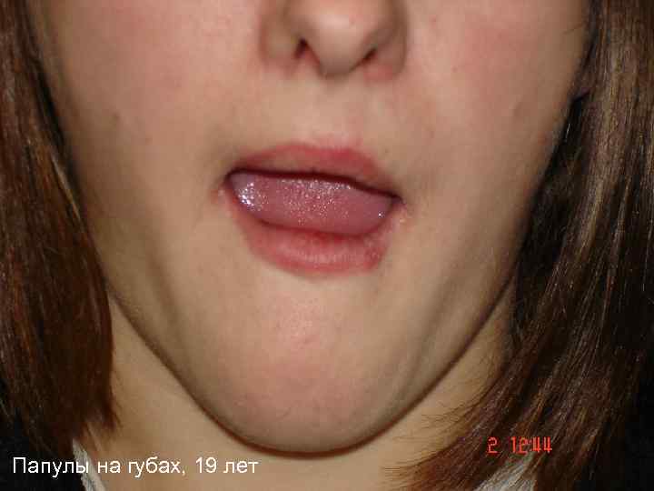 Папулы на губах, 19 лет 