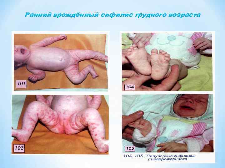 Ранний врождённый сифилис грудного возраста 