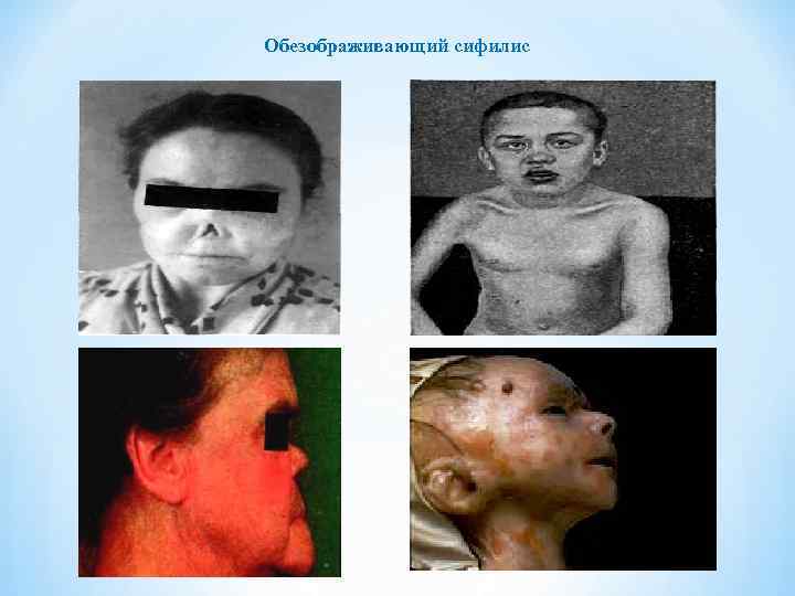 Обезображивающий сифилис 