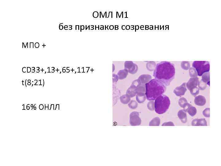 Острый миелоидный лейкоз прогноз. Острый миелобластный лейкоз вариант м1. Острый миелобластный лейкоз (м1-м2). Острый лимфобластный лейкоз гистология.